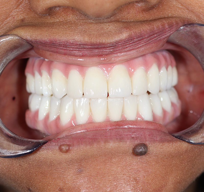 After treatment