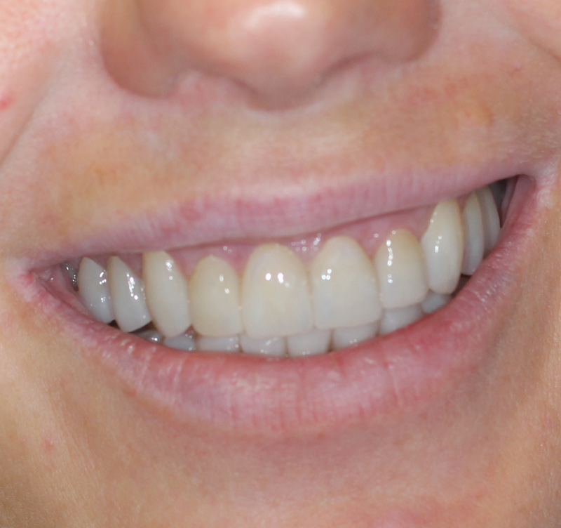 After treatment