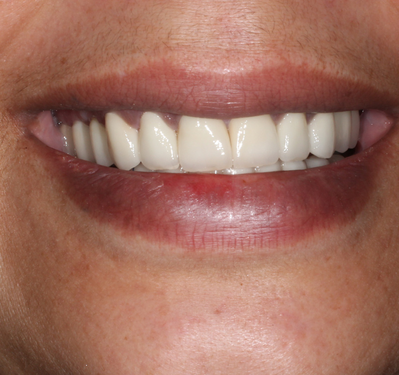 After treatment