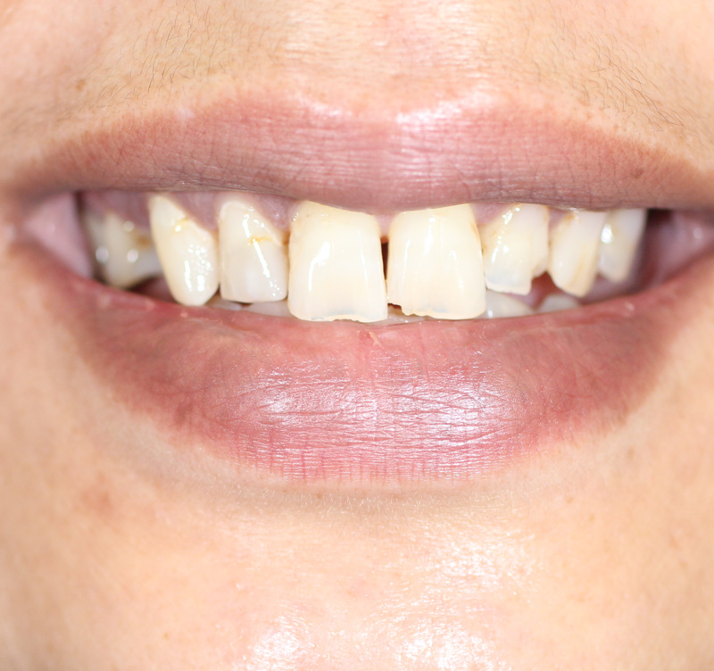 Before treatment