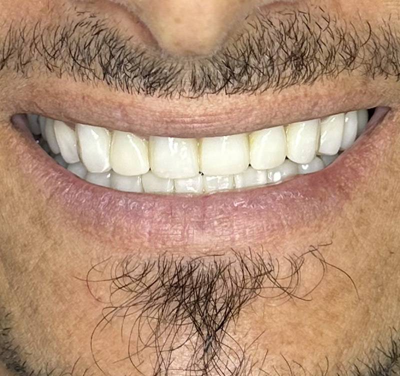 After treatment