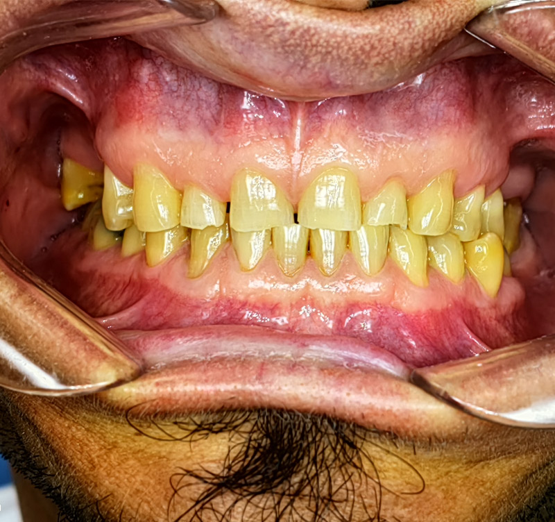 Before treatment