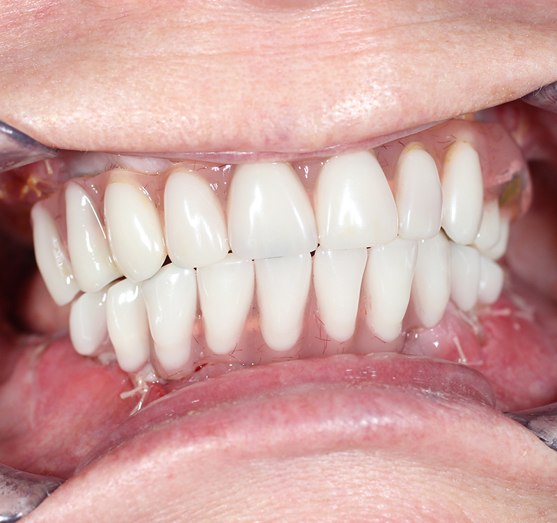 After treatment