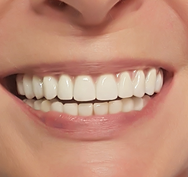 After treatment