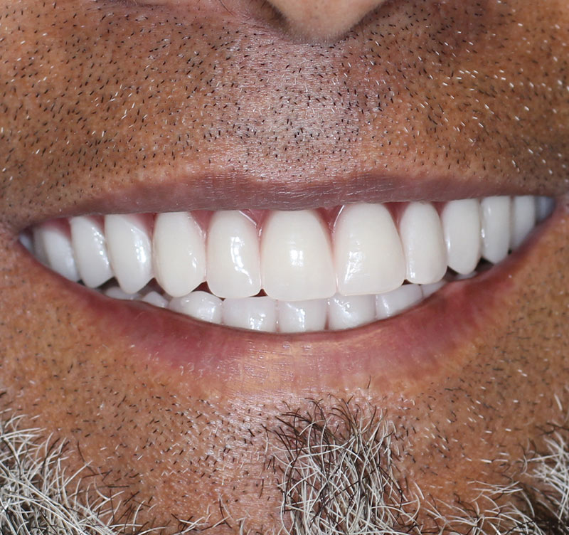 After treatment