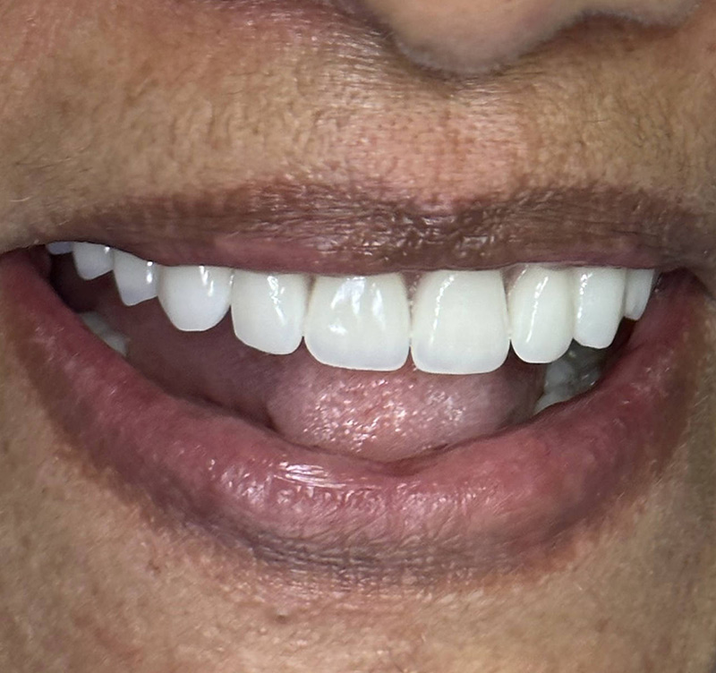 After treatment