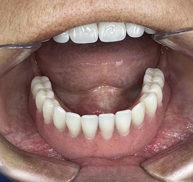 After treatment