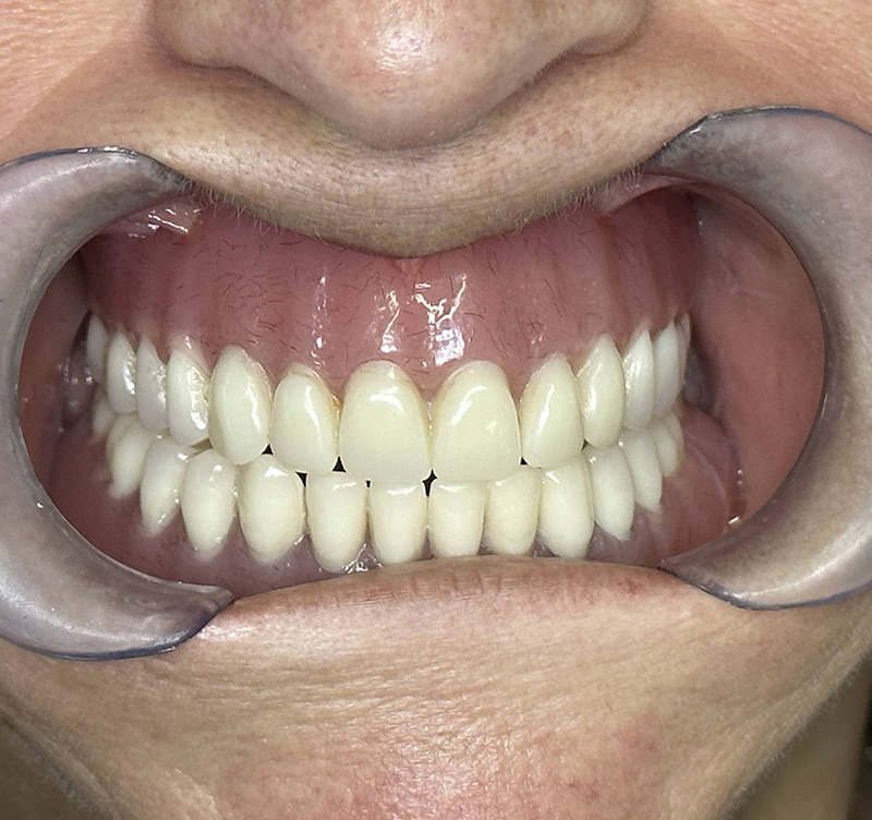 After treatment