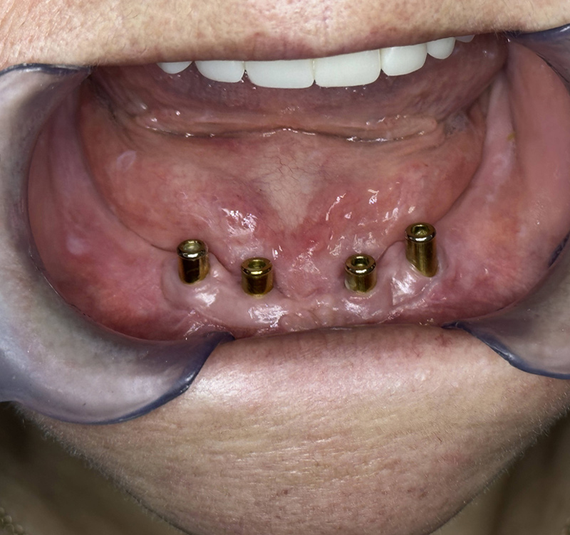Before treatment
